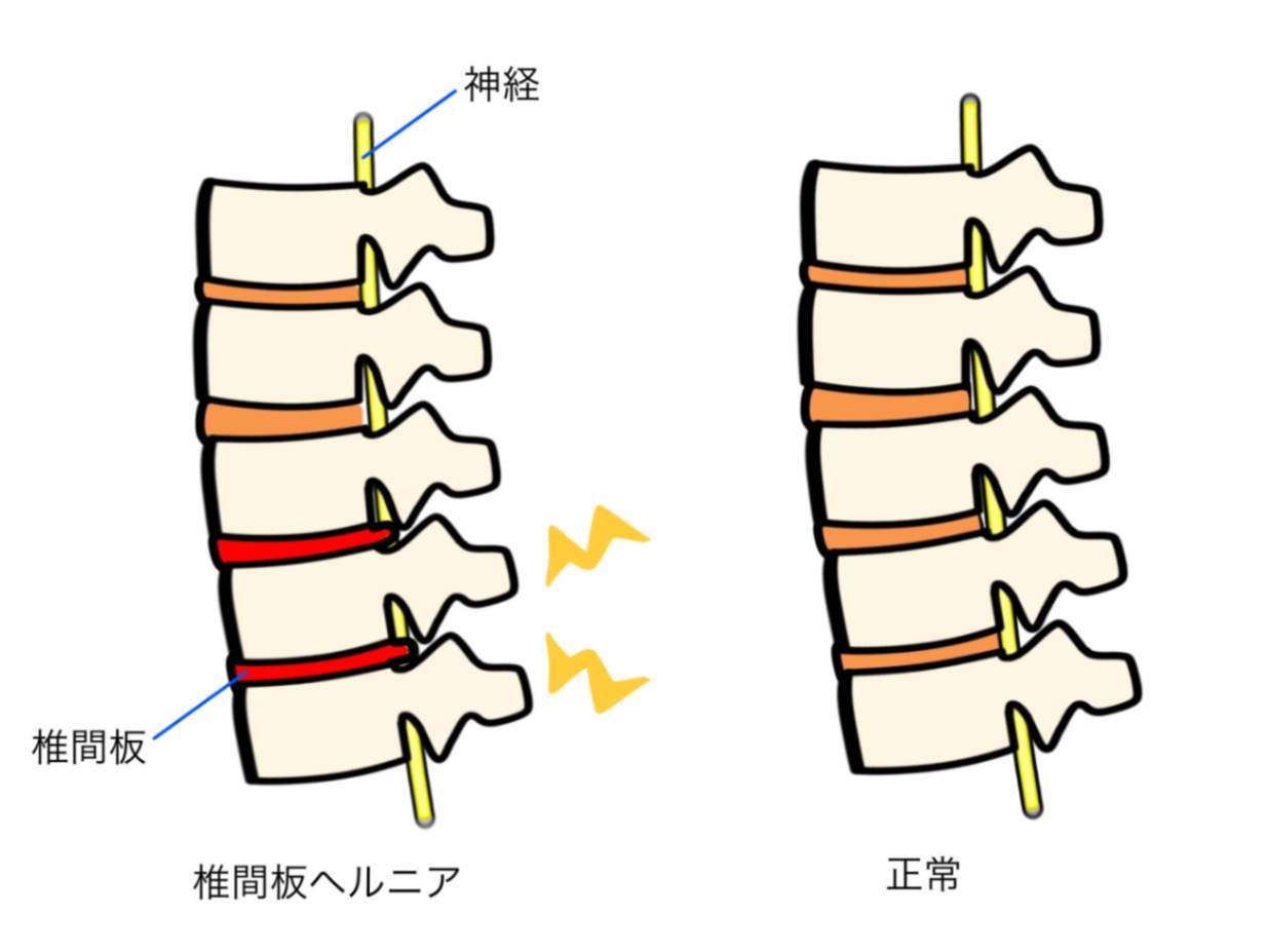 腰椎椎間板ヘルニアの原因